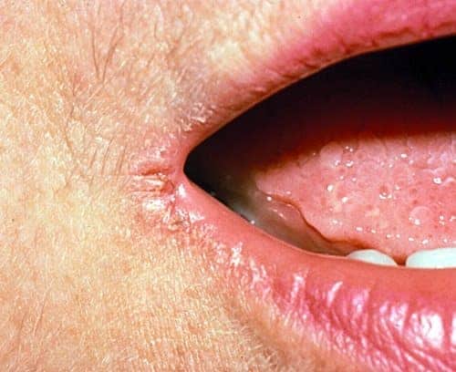 anglular cheilitis