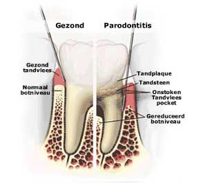 parodontitis