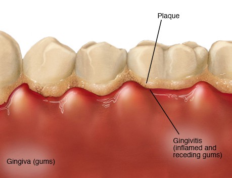 gingivitis